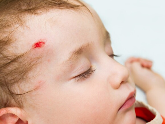 كيف تتصرفين عند تعرّض طفلكِ لإصابة في الرأس ومتى تتّصلين بالطبيب؟