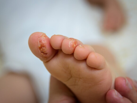 Eczema In Children