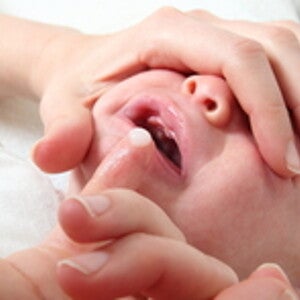 Oral Thrush: Signs and Remedies