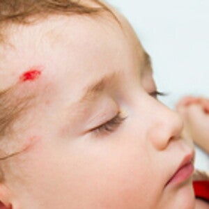 What To Do When Your Child Bumps His Head And When To Call The Doctor?