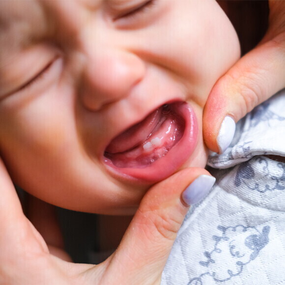Inflamed Gums Inflamed Gums