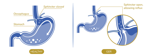 GASTRO-OESOPHAGEAL REFLUX